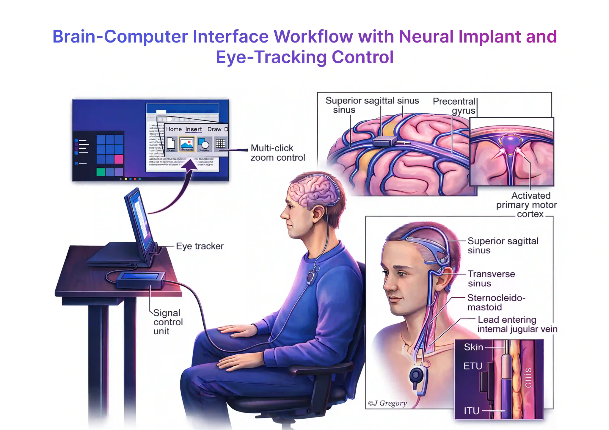 Neuralink脑机接口示意图
